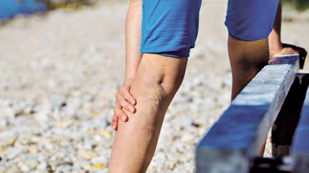 VÁRICES. Las padecen tanto hombres como mujeres.