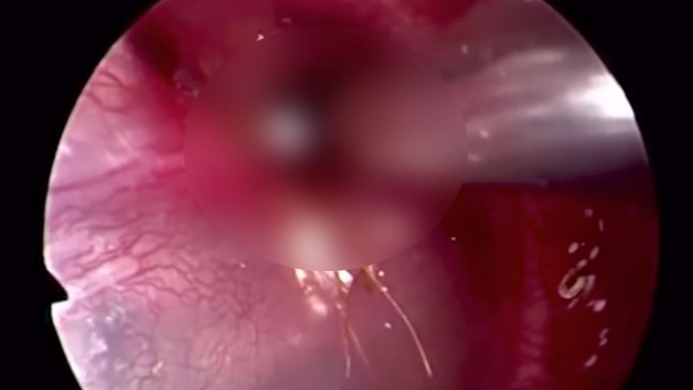 Desagradable sorpresa: le sacaron un bicho horrible del oído