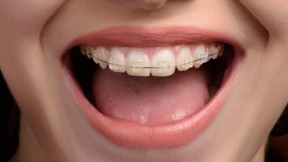 La forma m�s sencilla de eliminar el sarro en pocos pasos.