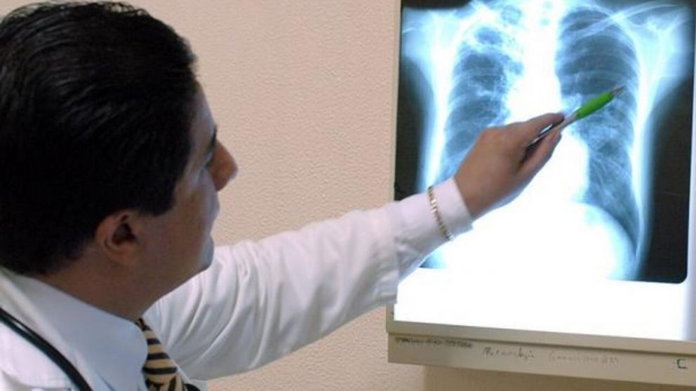 Aumentaron los casos de tuberculosis en nuestro país (imagen ilustrativa).
