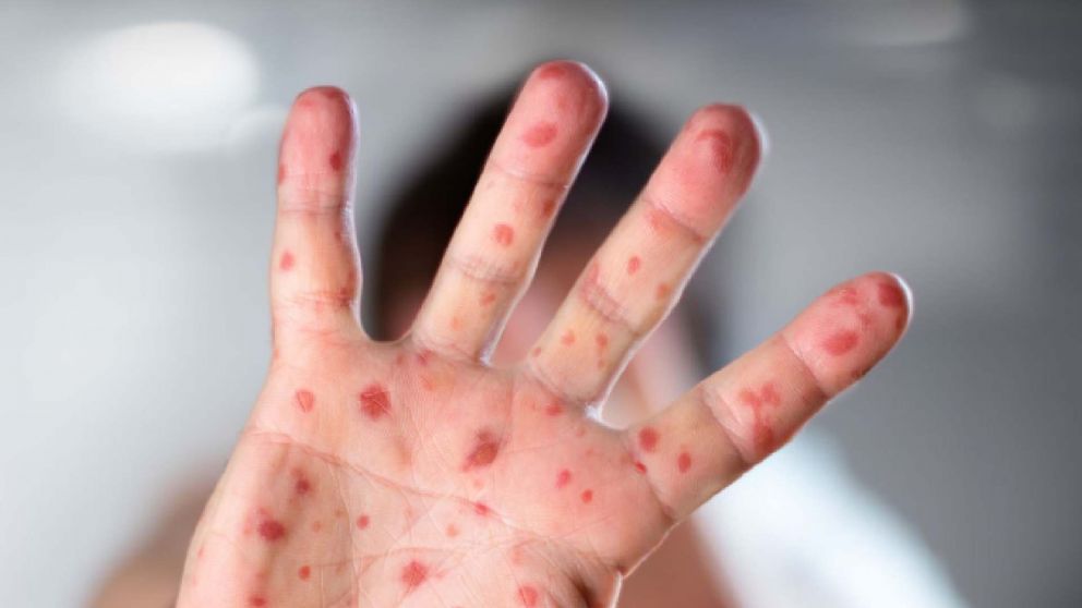 Son cuatro los brotes activos de sarampión en el país (Imagen ilustrativa).