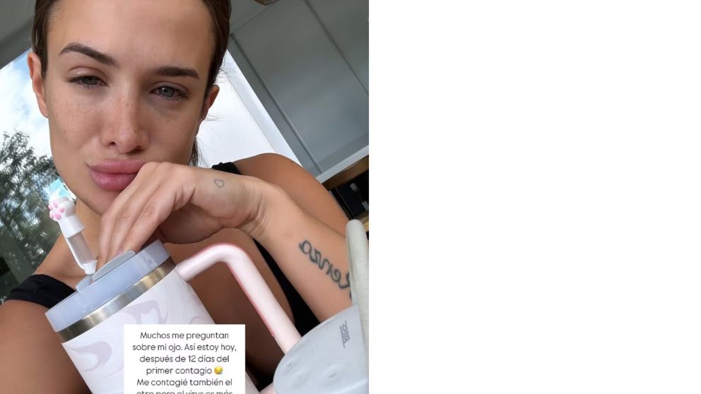 Cami Homs: "Es conjuntivitis viral
y se toma su tiempo en irse"