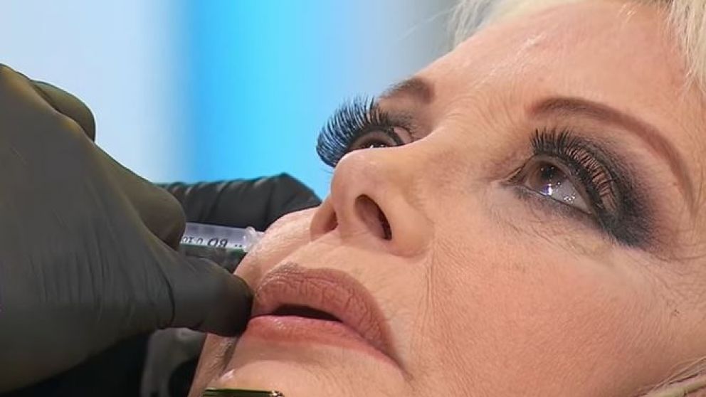Carmen Barbieri se aplicó botox en vivo.
