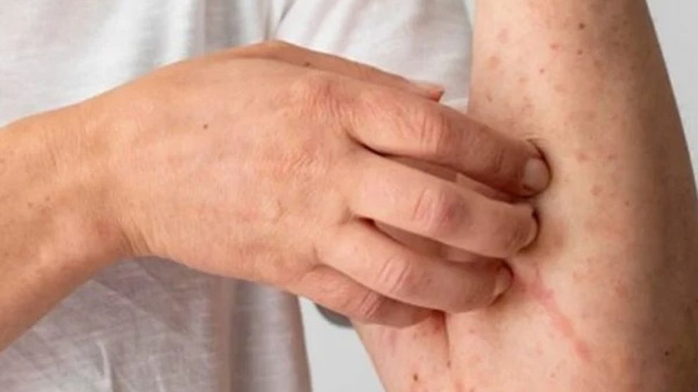 Ofrecen atención sin cargo para detectar dermatitis crónica: enterate cómo sacar turno y hasta cuándo