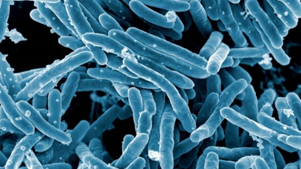 Esta enfermedad superó al Covid-19 como la infección más letal