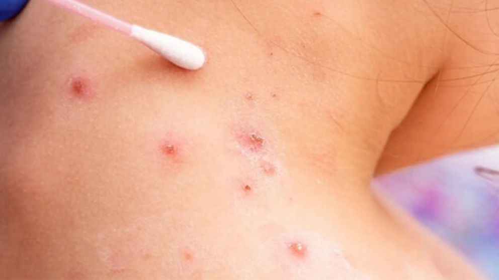 Viruela del mono: los síntomas de la enfermedad