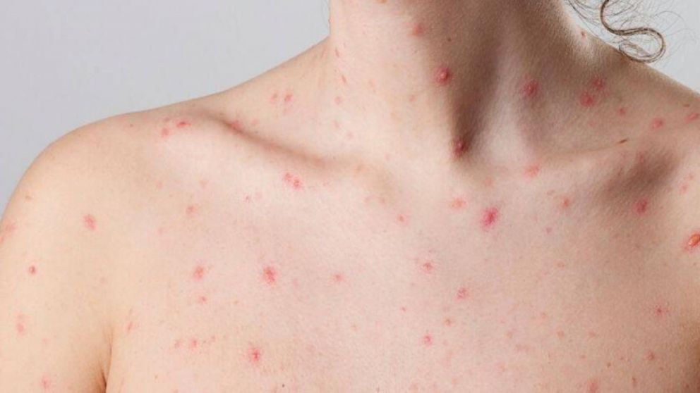 Alerta y preocupación de la OMS: qué es la viruela del mono