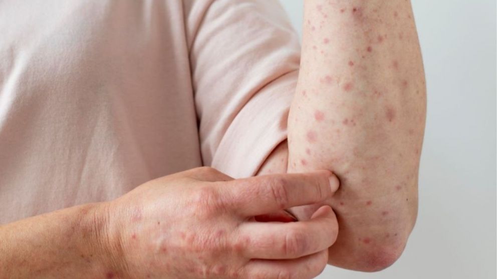 El sarampión es una enfermedad viral que se contagia a través del aire en forma de gotas expulsadas al toser, hablar o estornudar.