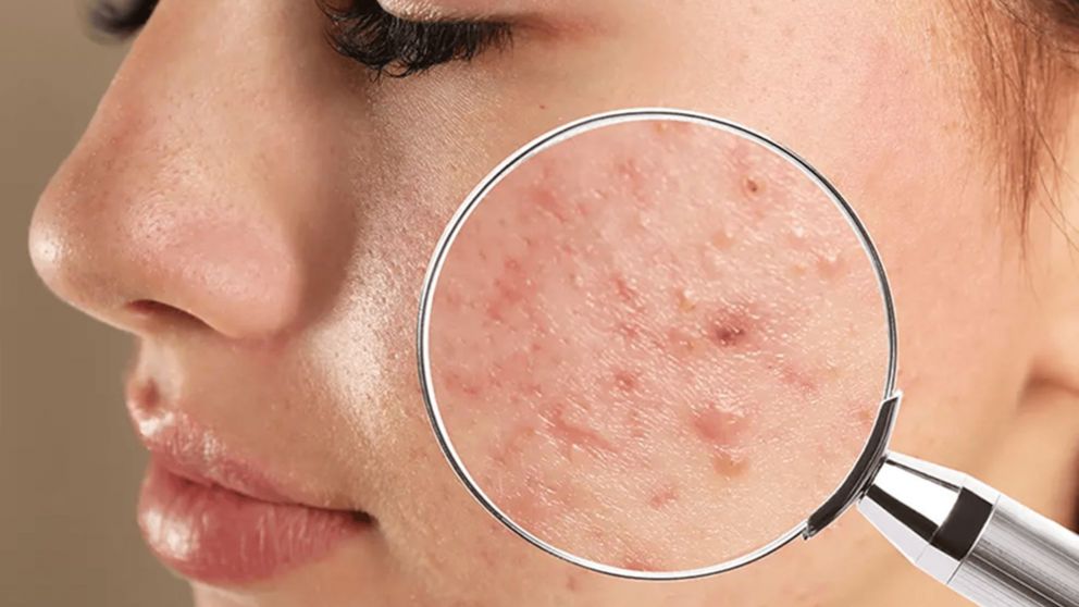 El acn� no debe ser tratado con dentr�tico seg�n la IA