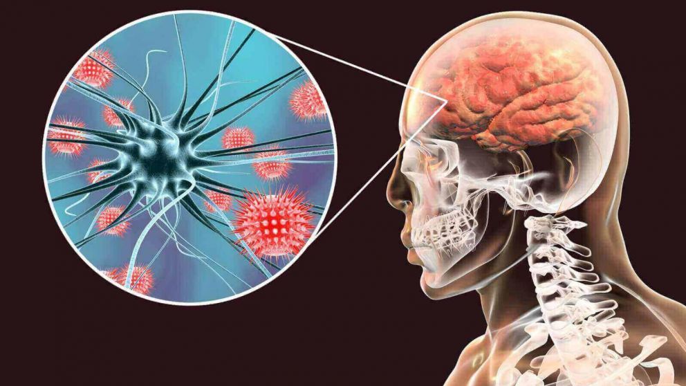 La meningitis suele aparecer en etapas de la infancia (Imagen ilustrativa).
