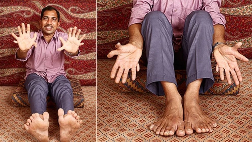 Es carpintero y tiene 28 dedos entre los pies y las manos.