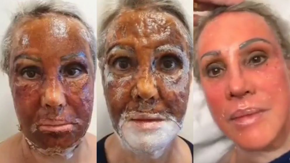 El tratamiento de rejuvenecimiento facial que es furor en las redes sociales.