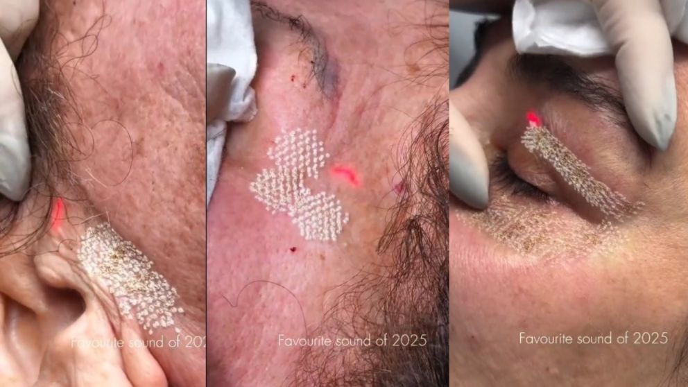 El paso a paso del lifting viral.