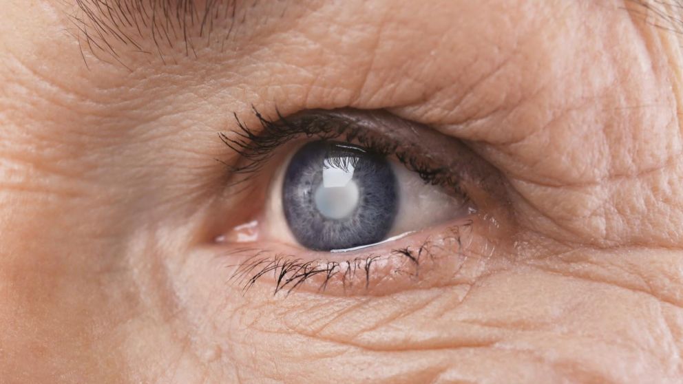 Millones de personas sufren de glaucoma (Imagen ilustrativa).