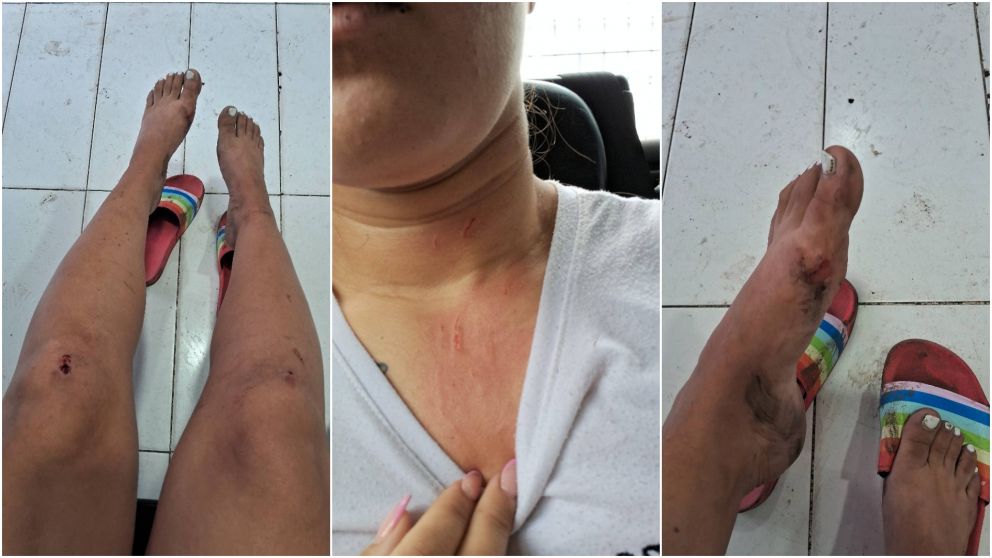 Las marcas en el cuerpo de la vida, luego de la golpiza sufrida d�as atr�s.