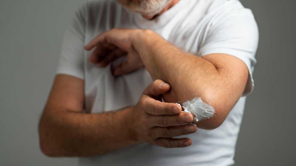 ANMAT prohibió cremas para el resfrío, quemaduras y dolores musculares (Freepik).