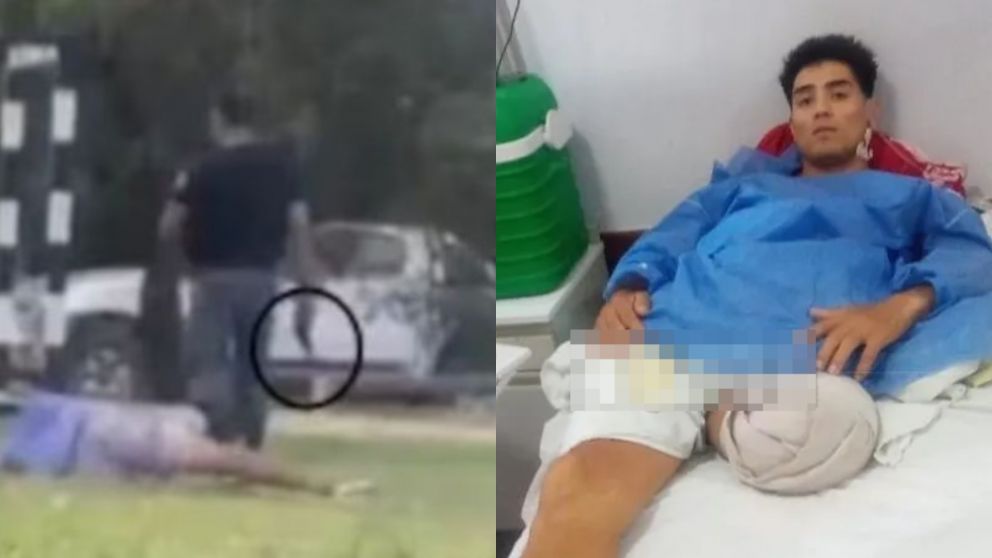 A la víctima le amputaron su pierna izquierda.