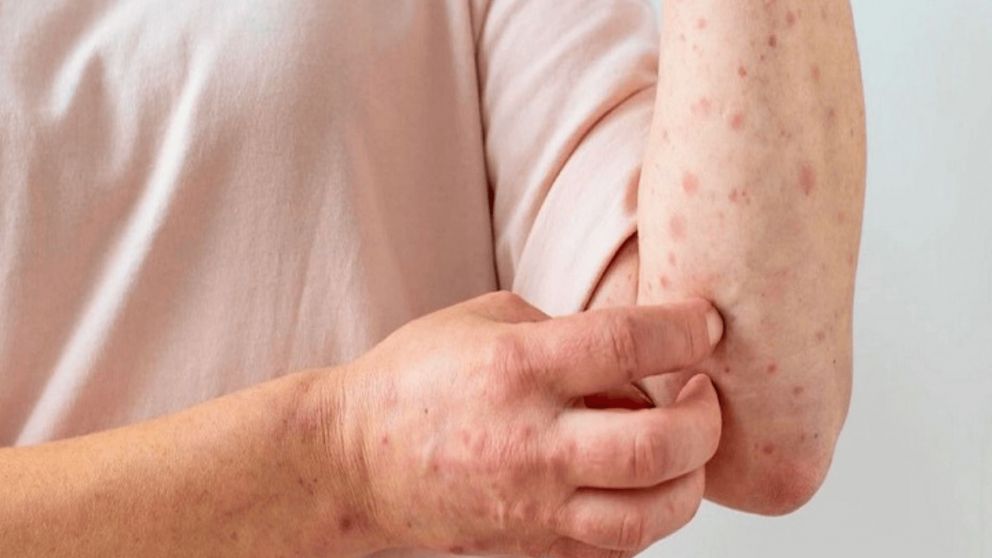 El boletín epidemiológico semanal indicó que los 10 nuevos casos de personas con viruela del mono son de la zona Centro del país (Imagen ilustrativa).