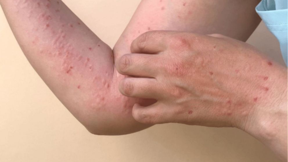 Confirmaron otro caso de viruela del mono en el Conurbano bonaerense (Imagen ilustrativa).