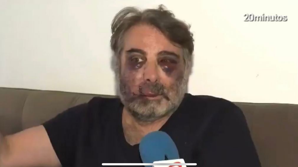 ESPAÑA: golpearon brutalmente a un hombre por pedir silencio y terminó en el hospital con el rostro desfigurado