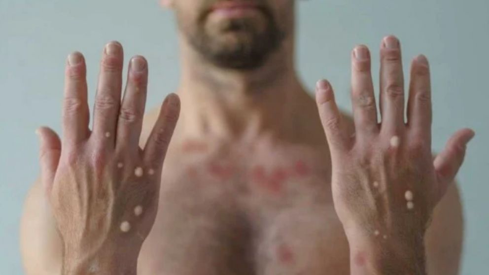 La OMS había delcarado una emergencia sanitaria mundial.