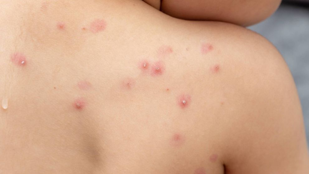 Viruela del mono: la Organización Mundial de la Salud declaró la emergencia internacional por el avance de la enfermedad