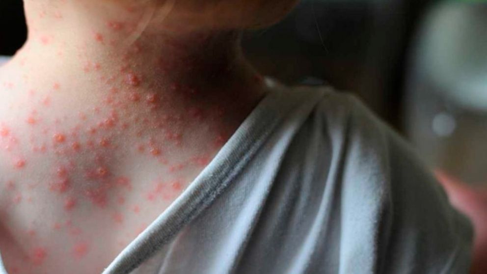 La OMS declaró la situación como una “emergencia de salud pública de importancia internacional”.