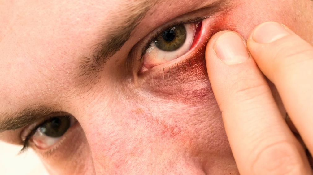 El ojo seco est� dividido en tres categor�as (Imagen ilustrativa).