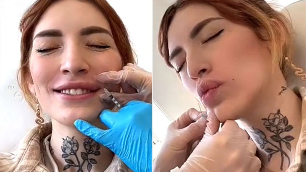 La edad promedio de las pacientes que se inyectan ácido hialurónico bajó de los 35 a los 20 años.