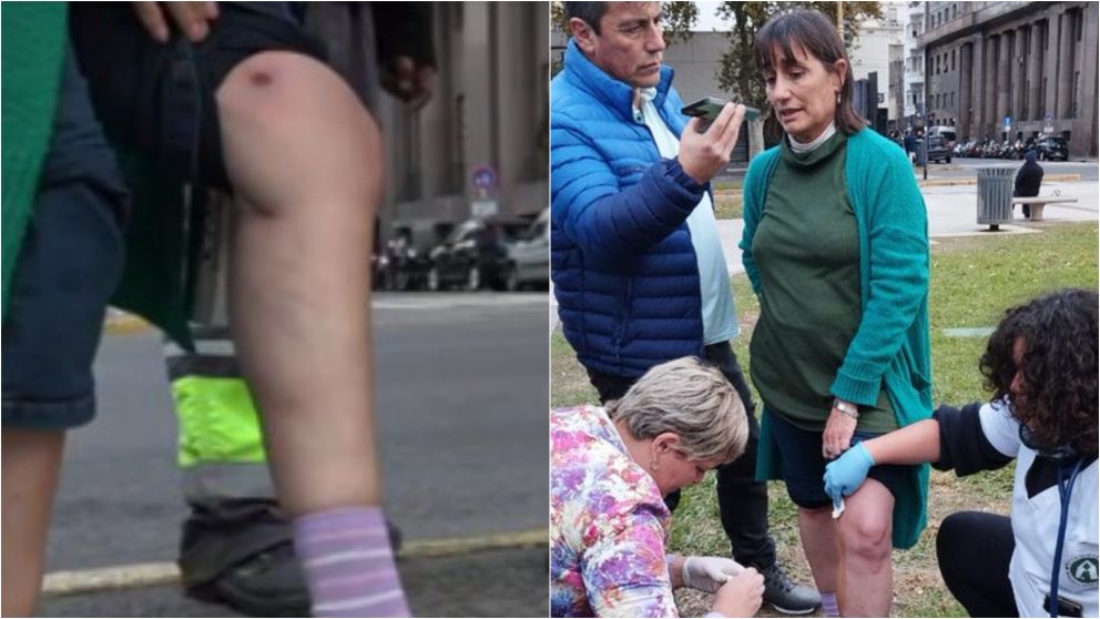 La diputada nacional recibió dos impactos de bala de goma.