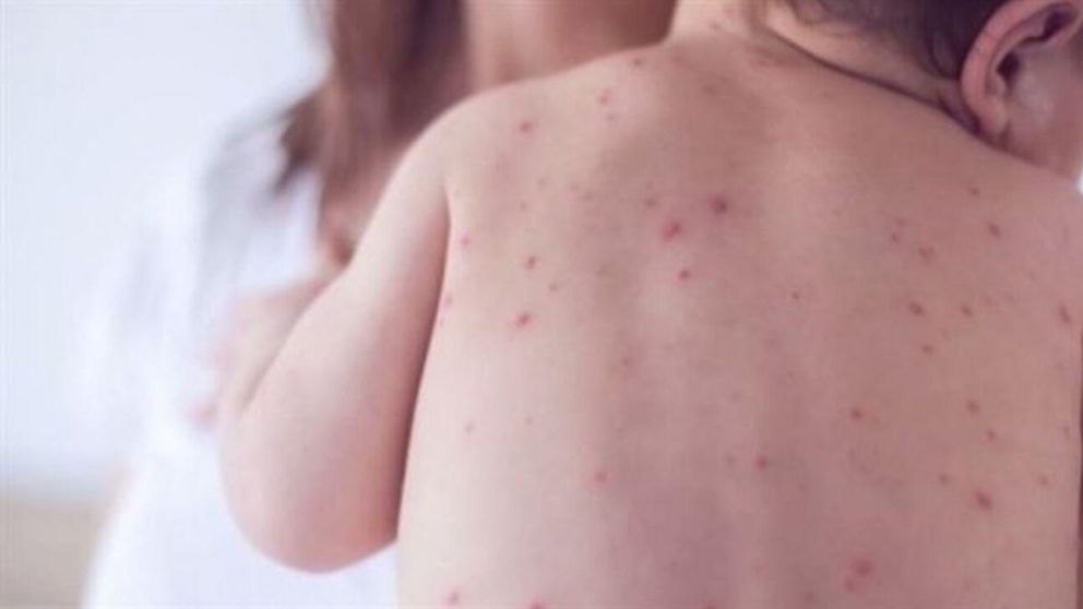 El sarampión puede ser prevenible por medio de una vacuna (Imagen ilustrativa).