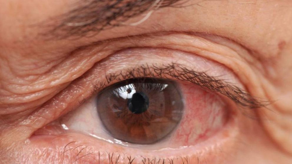 El glaucoma puede traer serias complicaciones oculares en el futuro si no se lo trata (Imagen ilustrativa).