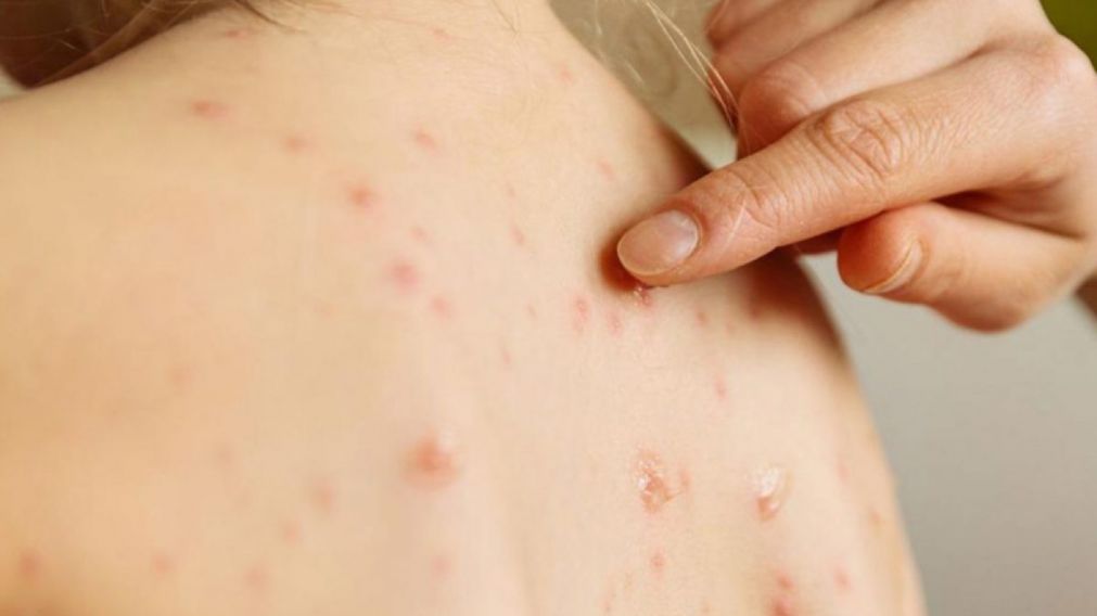 Desde la cartera de Salud informaron que el nene afectado arribó al país procedente de España, en medio del aumento de infecciones por sarampión registradas en Europa.