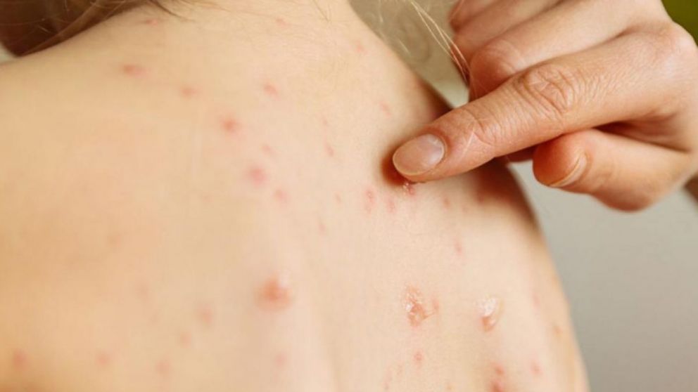 Desde la cartera de Salud informaron que el nene afectado arribó al país procedente de España, en medio del aumento de infecciones por sarampión registradas en Europa.