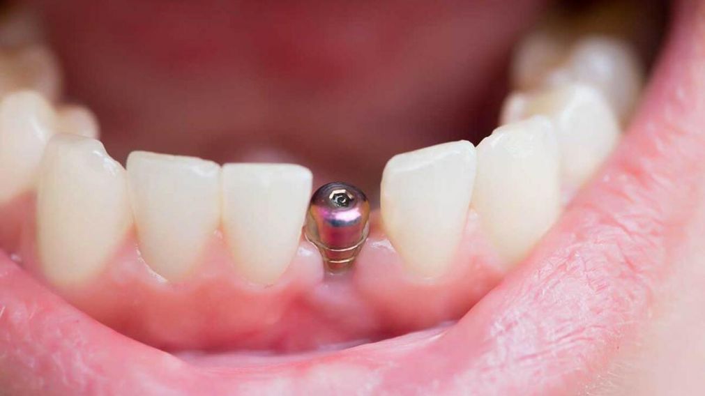 ANMAT retiró del mercado una marca de implante dental (Imagen ilustrativa).