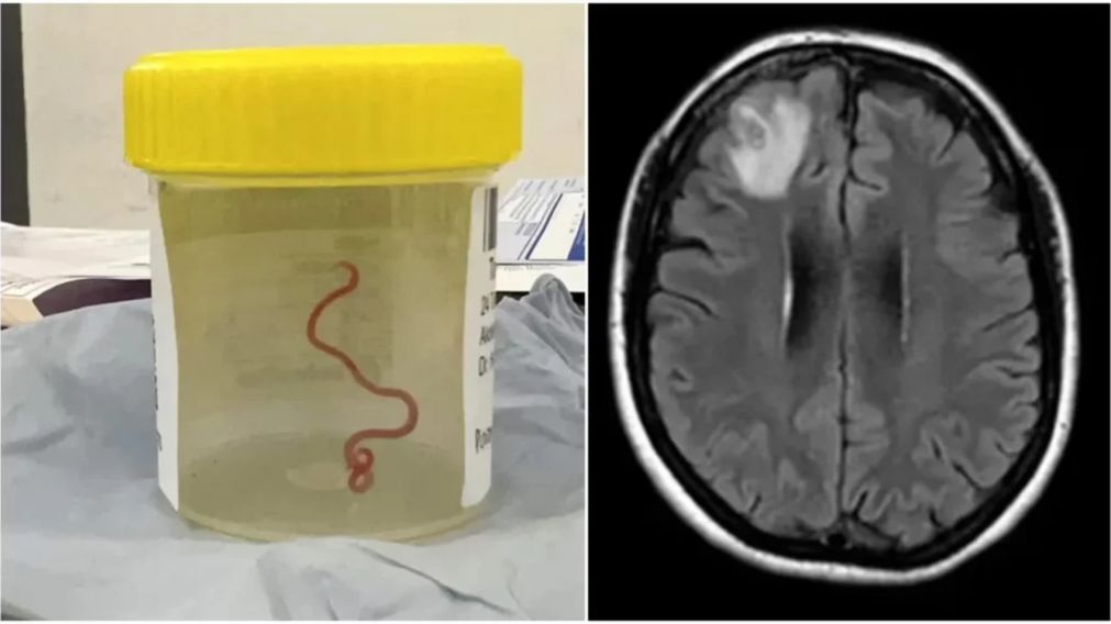 Una mujer sufri� misteriosos s�ntomas por a�os y descubrieron que ten�a algo impactante en el cerebro (Imagen Canberra Health).