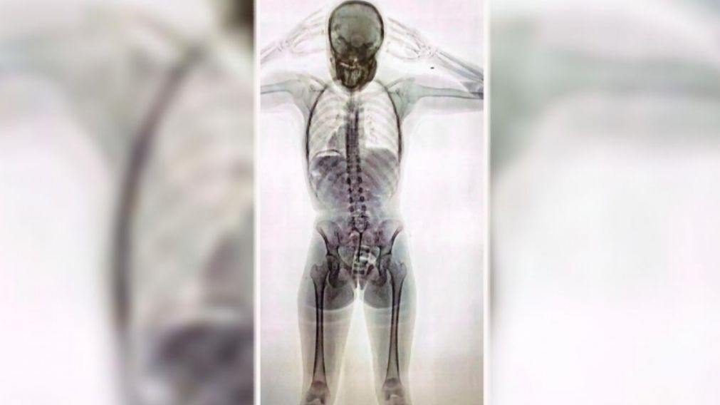 La muestra de las capsulas de droga que llevaba la joven en su cuerpo.
