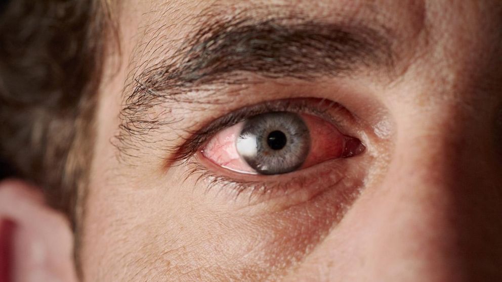 La conjuntivitis es sumamente contagiosa (Imagen ilustrativa).
