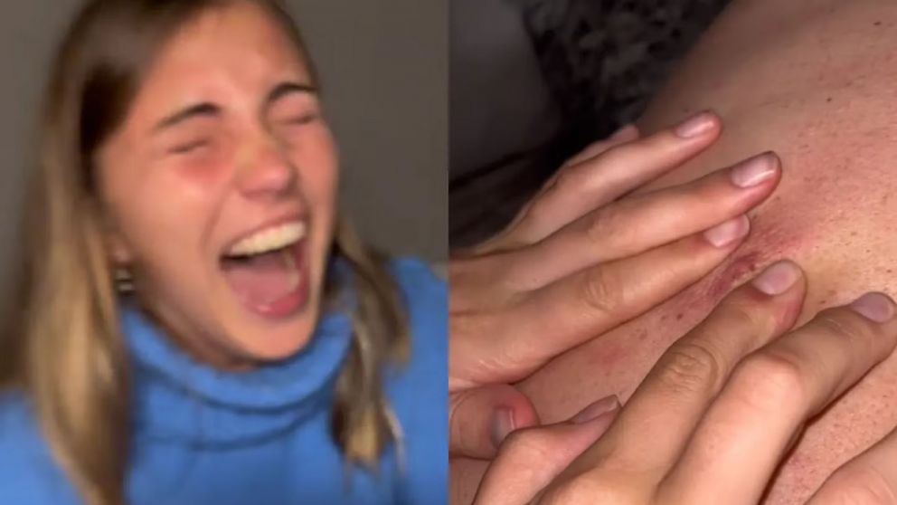 Le explot� un grano a su pap� y termin� todo mal.