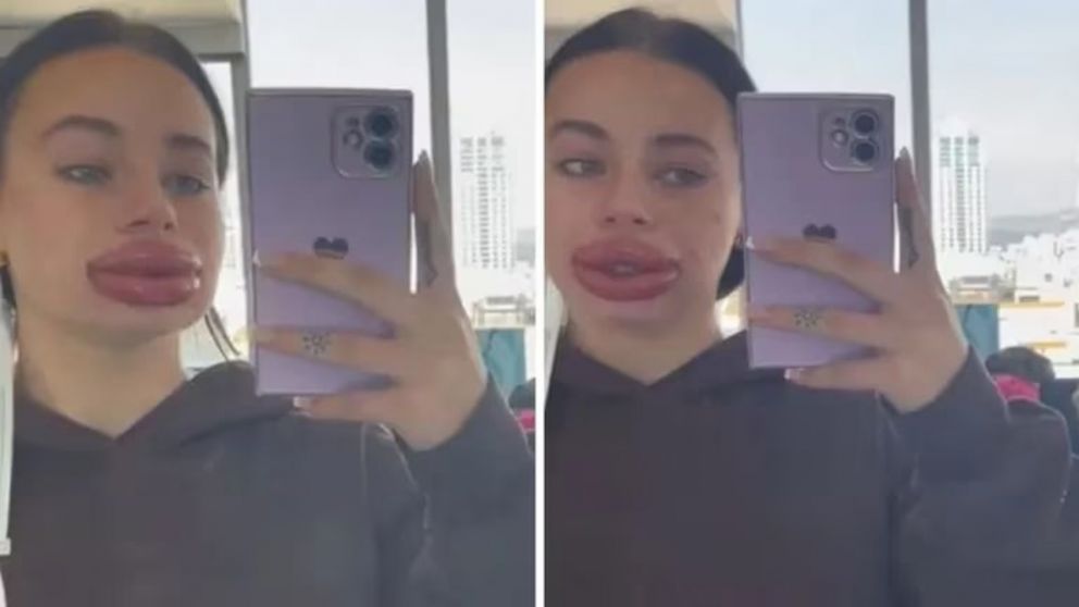 Joven se rellenó los labios con ácido hialurónico y el impactante resultado se viralizó (Imagen captura vídeo).