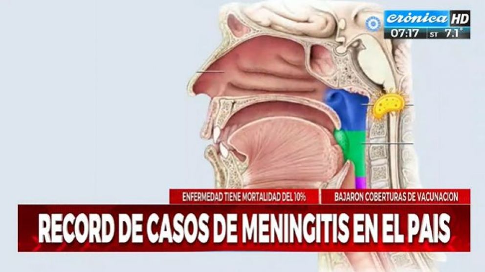 Preocupación por el aumento de casos de meningitis en el país