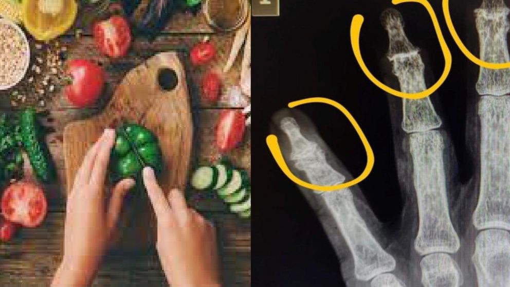 "Sigan diciendo que el veganismo es sano": la impresionante foto que muestra los dedos de una mujer que lleva una dieta vegana.