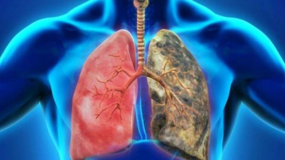 El EPOC afecta más a los hombres que a las mujeres (Imagen ilustrativa).