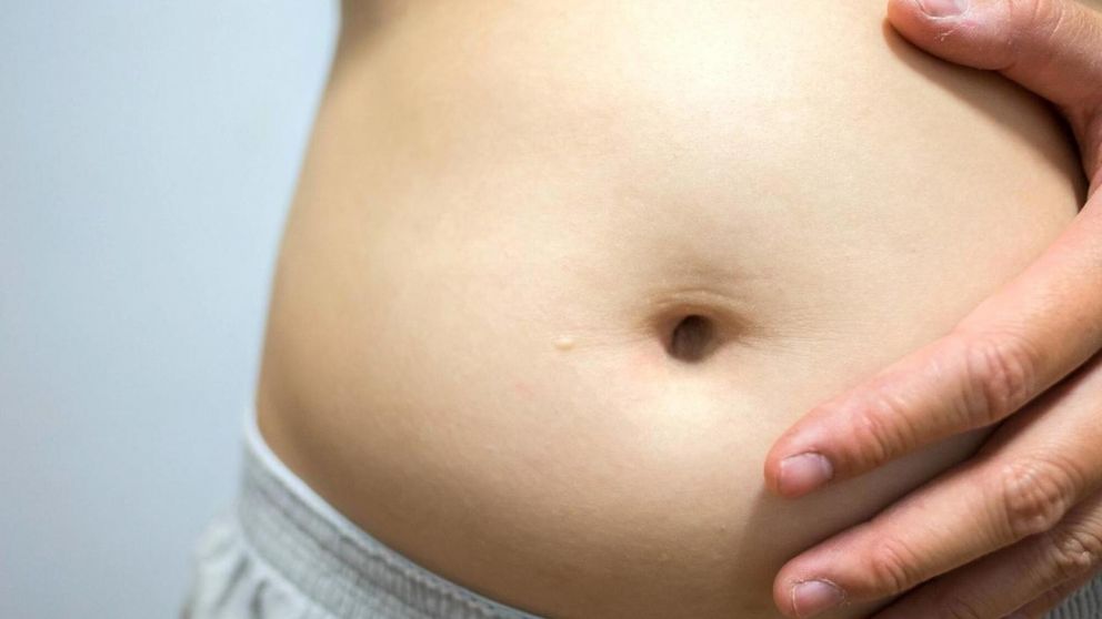 ¿Qué es el SIBO?: los especialistas hablan sobre la patología que es tendencia en redes.