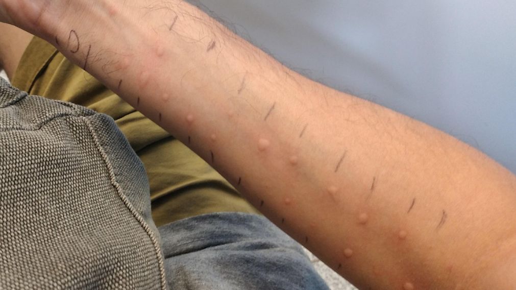 El colmo: contó el inesperado resultado de su estudio de alergias y se volvió viral.