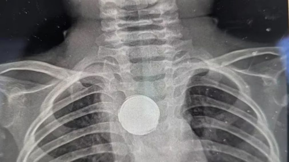 Un nene de 5 años se tragó una pila, le quedó trabada en el esófago y se salvó de milagro (Imagen redes sociales).