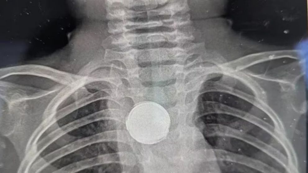 Un nene de 5 años se tragó una pila, le quedó trabada en el esófago y se salvó de milagro (Imagen redes sociales).