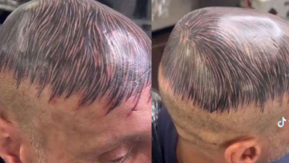Un hombre decidió tatuarse "pelo" para ocultar su calvicie y el increíble resultado se volvió viral (Imagen captura vídeo).