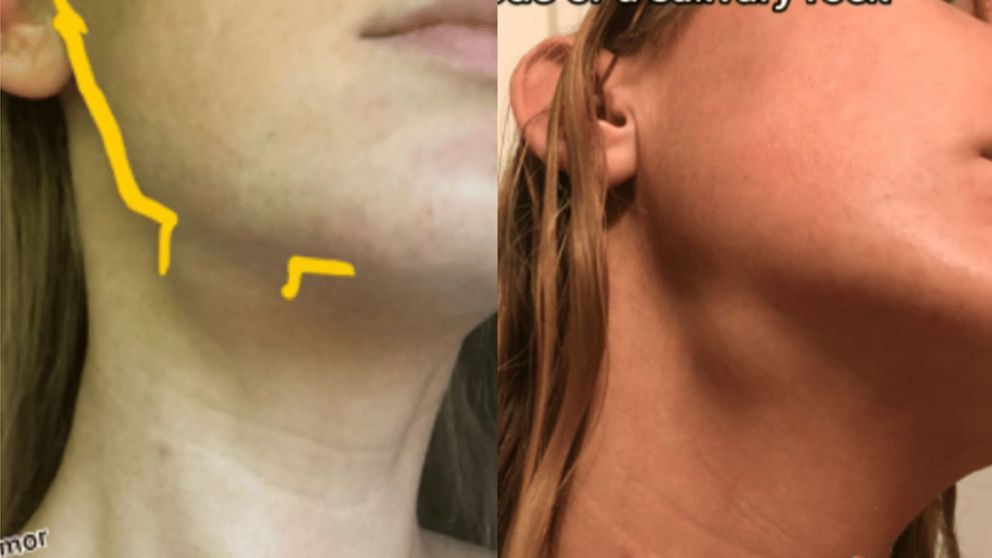 Una joven estadounidense se dio cuenta de un inconveniente de salud por Tiktok.