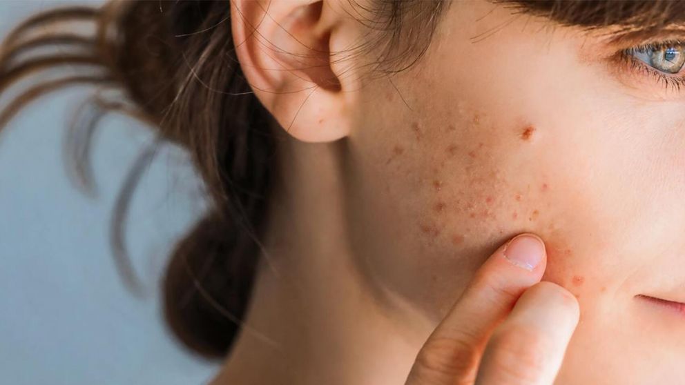 Una mujer fue al médico por un grano en la cara y recibió un diagnóstico devastador (Imagen ilustrativa).